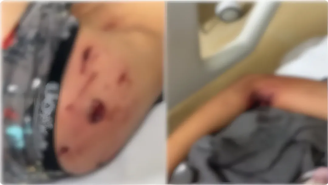 Criança é atacada por pitbull ao buscar pipa na casa de vizinho em Itumbiara