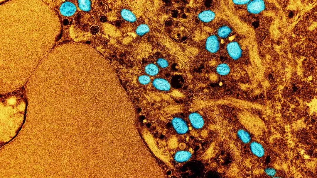 OMS declara que mpox deixa de ser emergência de saúde pública internacional