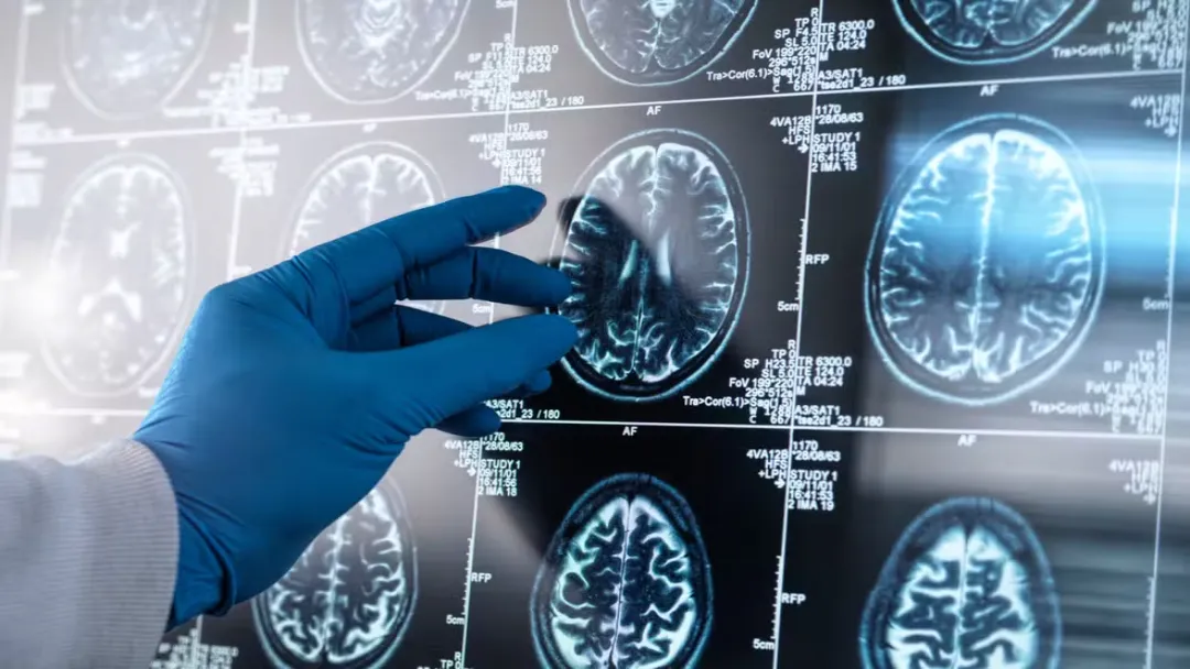 Cientistas Brasileiros: Inflamação Causa Progressão do Alzheimer