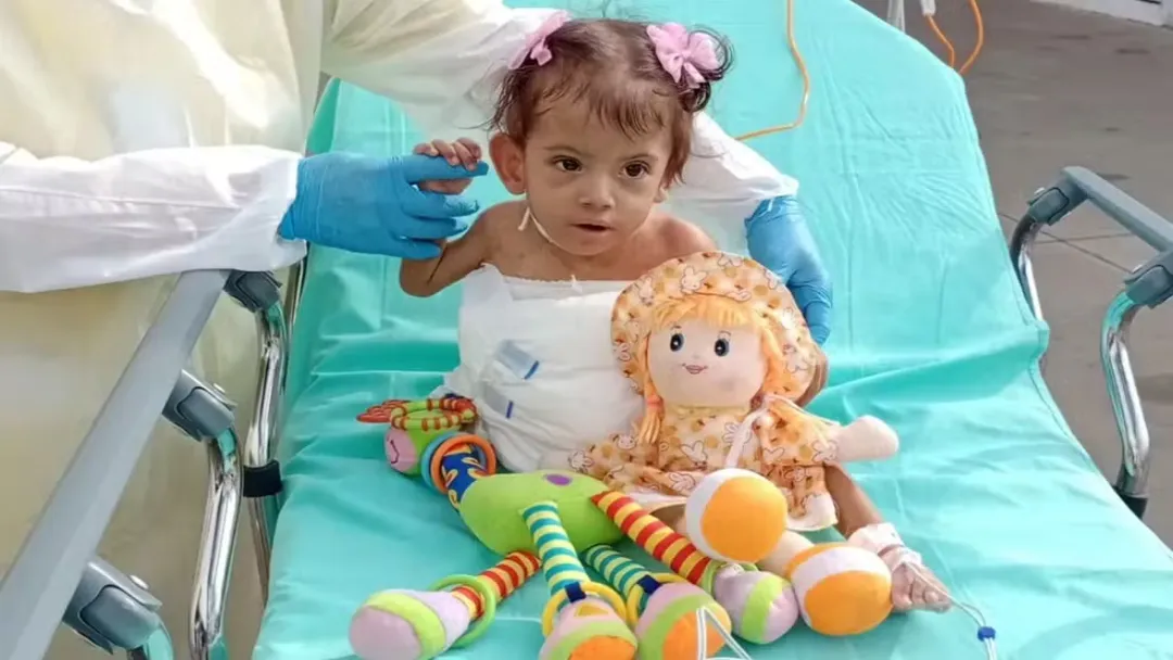 Morre Aruna, gêmea siamesa que lutava pela vida após separação em GO