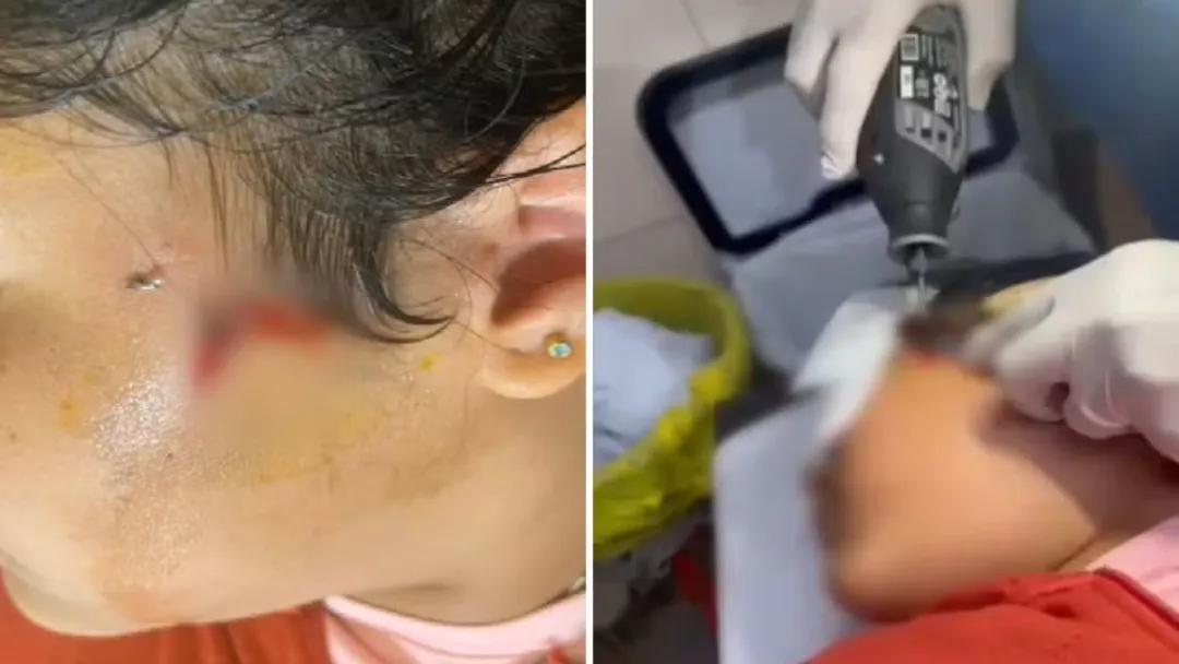 Criança fica com anzol preso no rosto em Luziânia