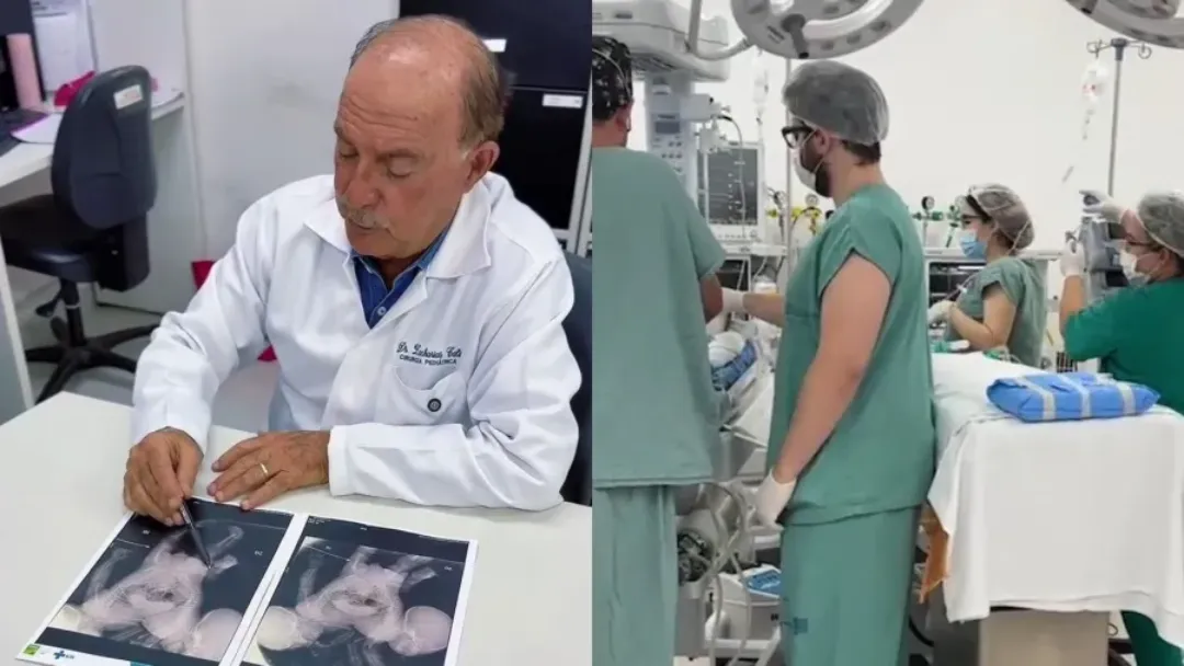 Morrem em Goiânia gêmeos siameses após cirurgia de emergência
