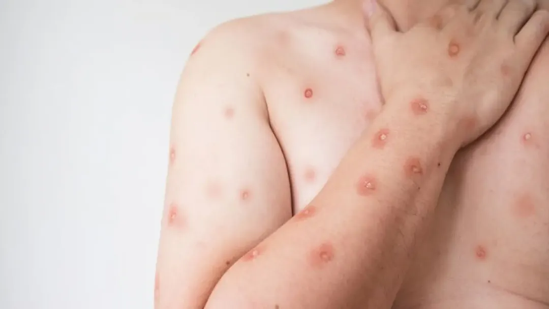 Goiás investiga 11 casos suspeitos de Mpox; veja orientações da SES