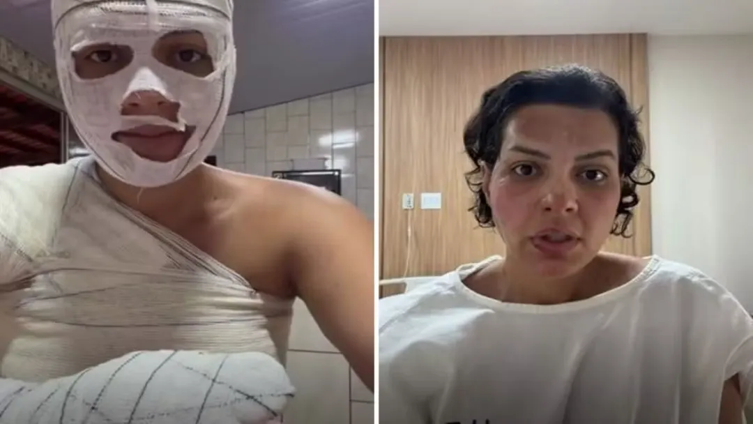 Nutricionista sofre queimaduras graves e faz alerta