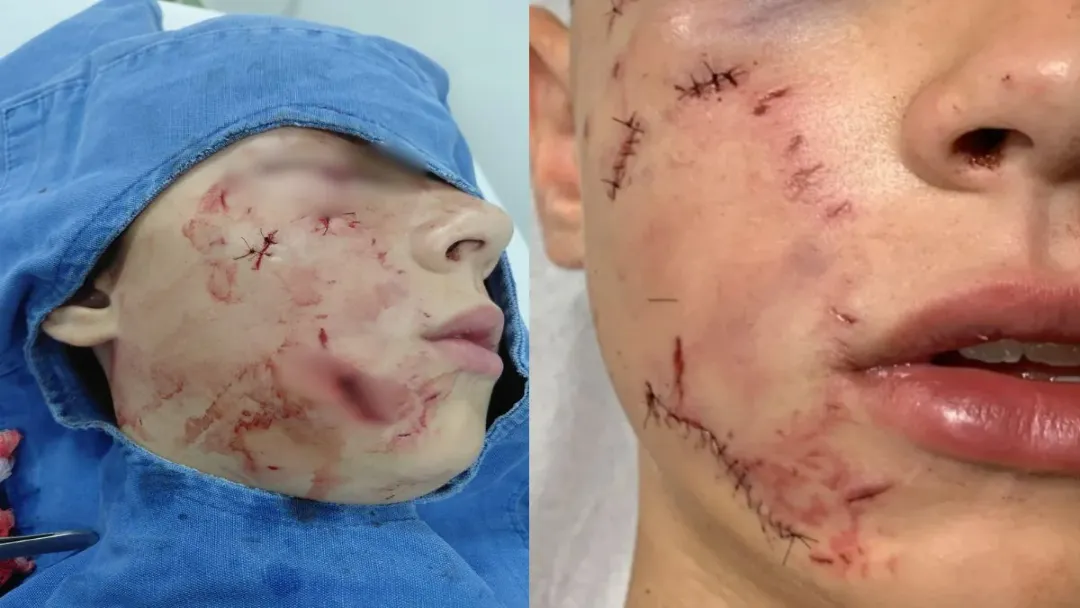 Menino de 10 anos é atacado por pitbull na calçada em Anápolis