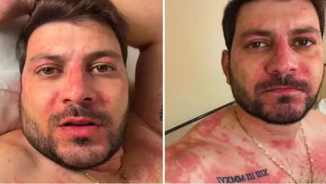 Ex-BBB Caio Afiune vai parar no hospital após alergia